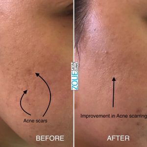 Acne-Scar-Treatment-Before-After
