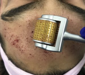 Micro-Needling-RF