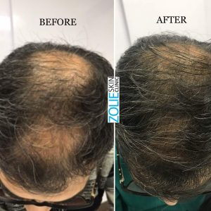 before and after photos of PRP treatment