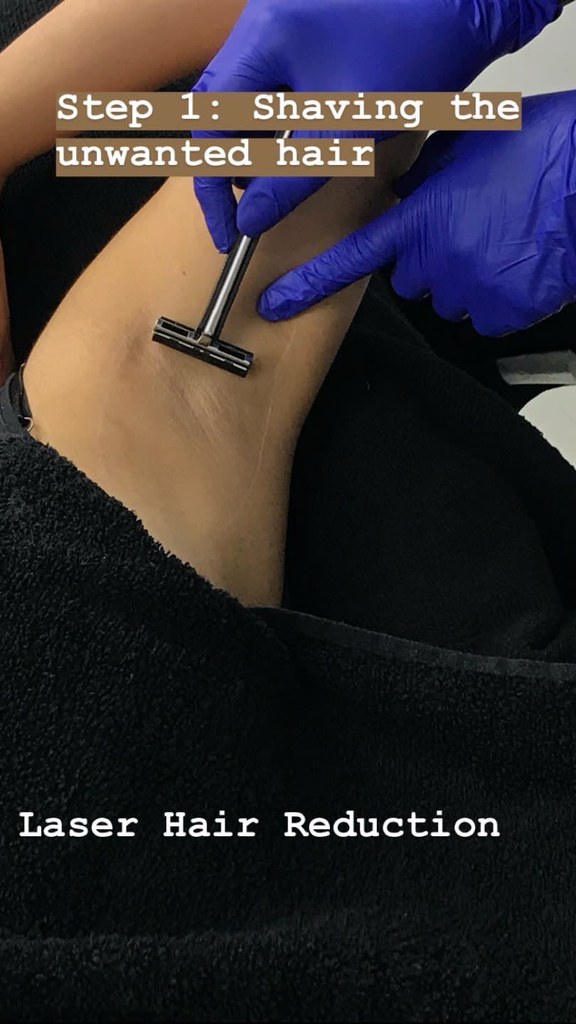 Laser Hair Reduction Preparation