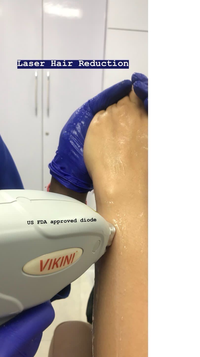 Laser Hair Reduction Procedure