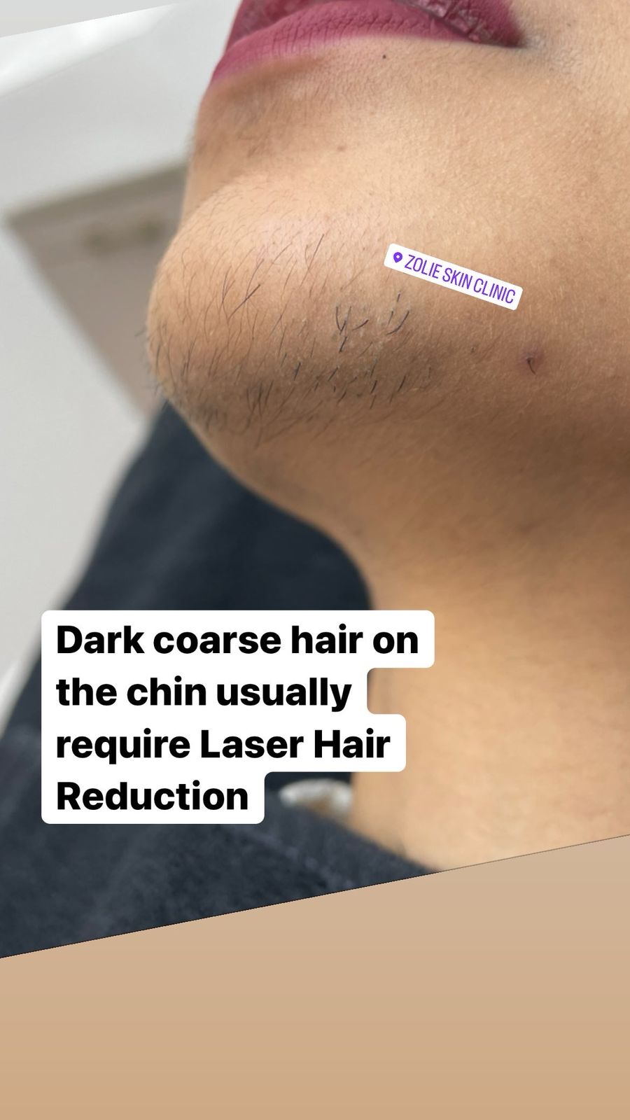 Laser Hair Reduction Procedure